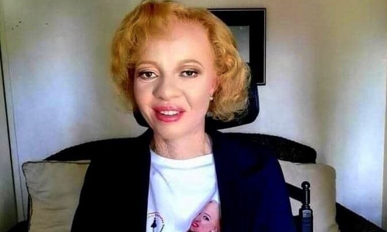 Zim: Fighting GBV against women & girls with albinism